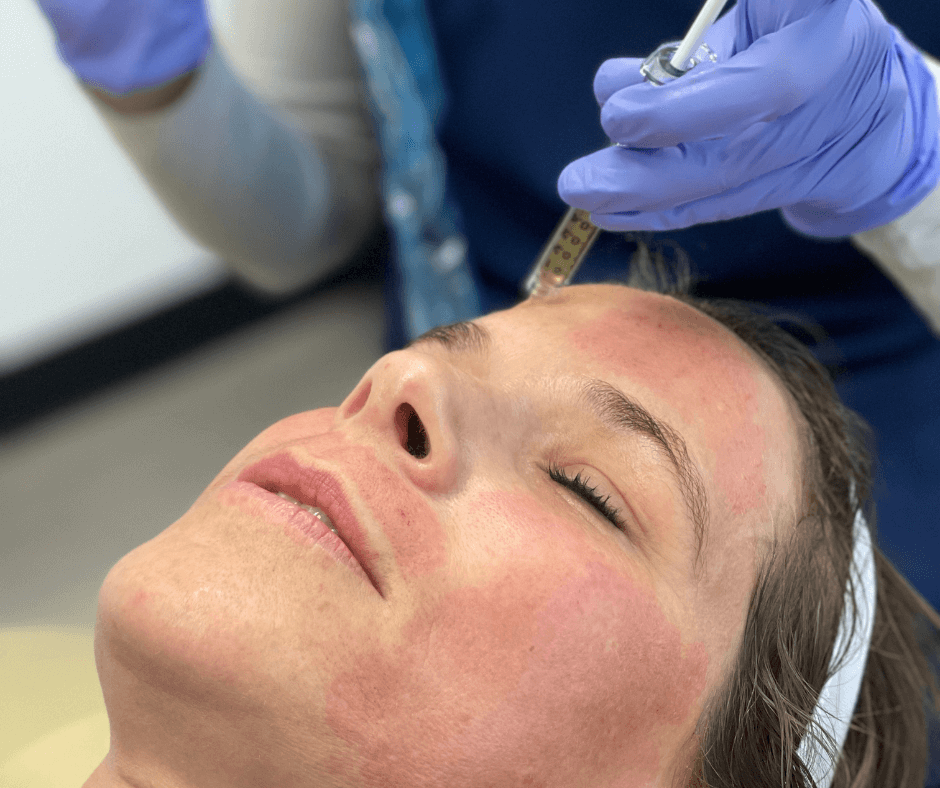 a person getting a botox injection
