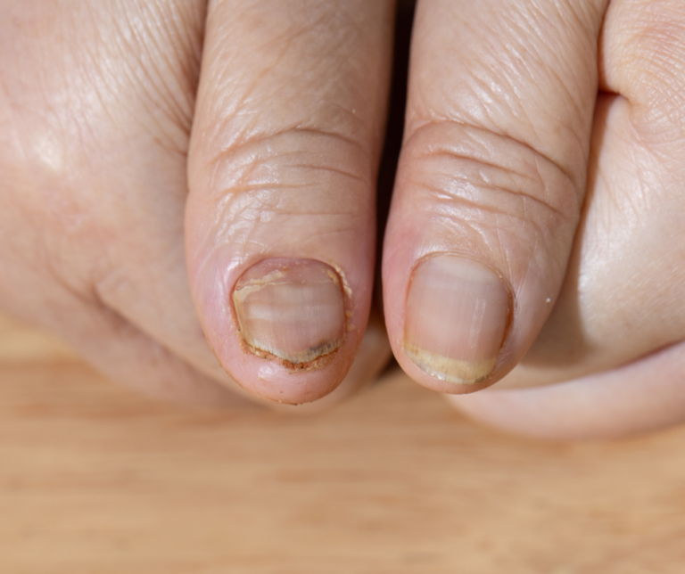 Nail Changes - Montrose Dermatology and Cosmetics - Dr. Renata Raziano