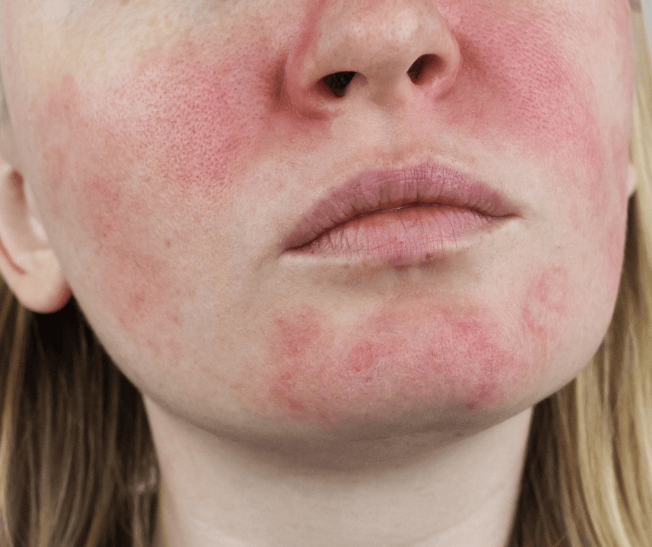 rosacea rash on a woman's face